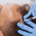 Exosome Hair Therapy London: The Complete Guide to Revolutionary Hair Loss Treatment