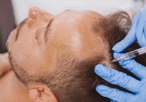 Exosome Hair Therapy London: The Complete Guide to Revolutionary Hair Loss Treatment