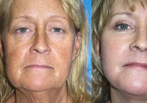 Can stem cells reverse ageing?